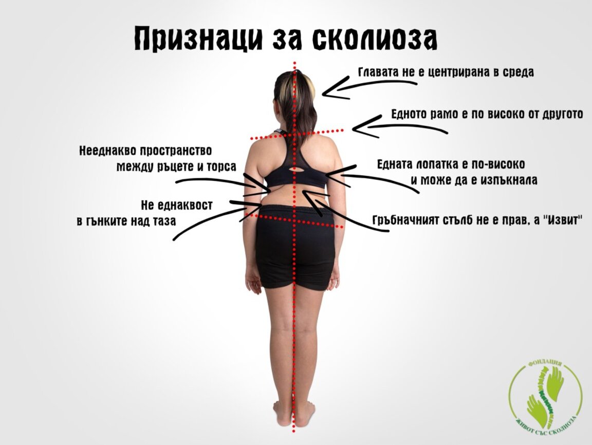 Сколиозата идва тихо и остава до живот