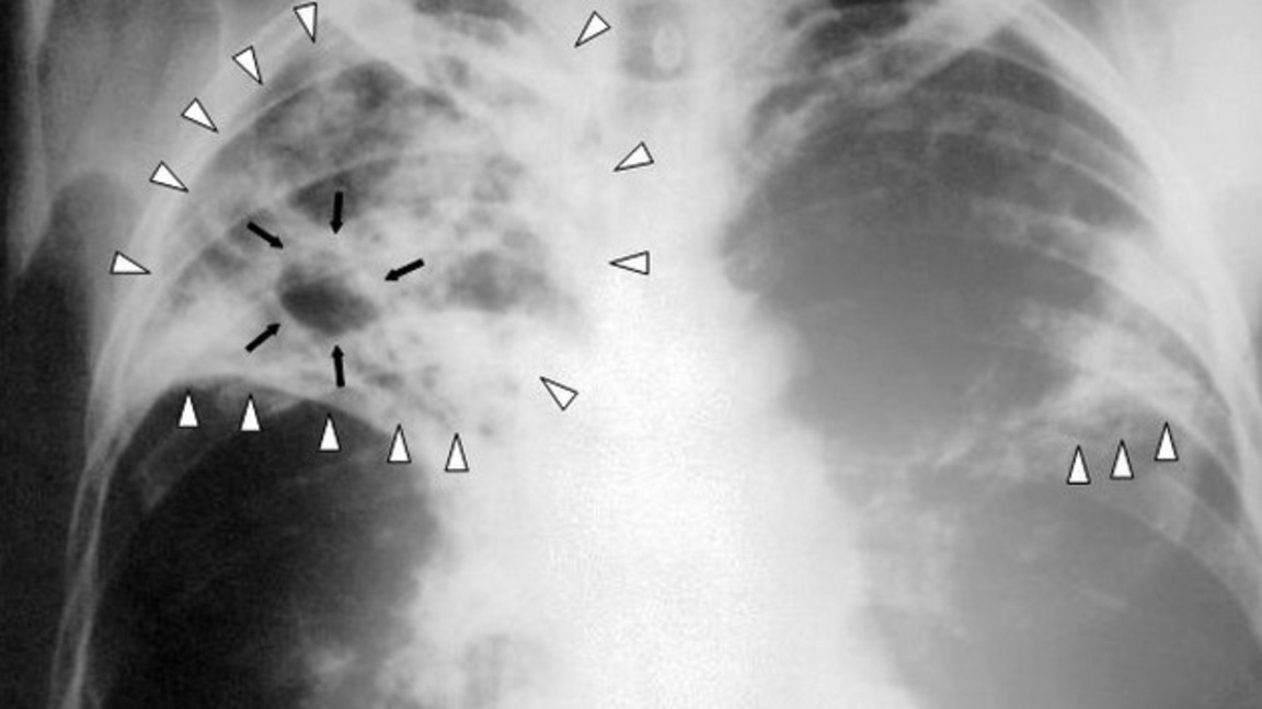 Безплатни прегледи в Троян за Световния ден за борба с туберкулозата