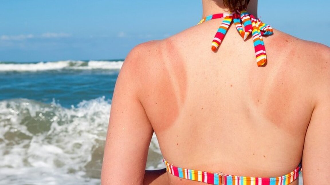 Доц. Антон Тачев: Летният загар на кожата не е здраве, това е самозащита чрез пигментация