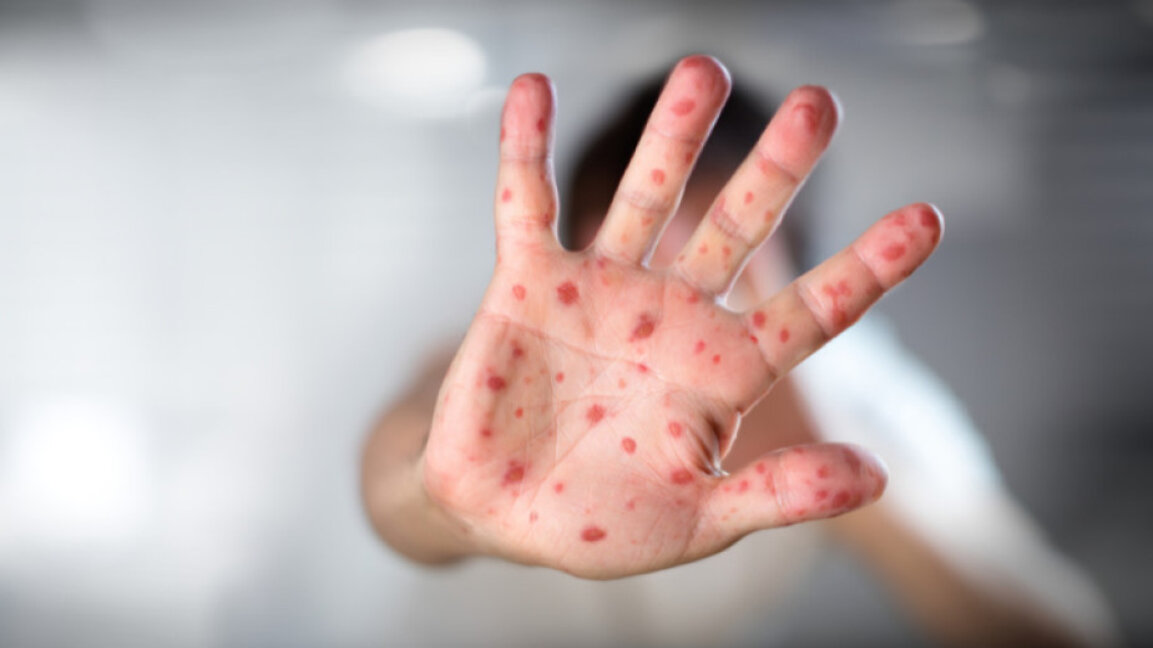 Обичайна заболеваемост от варицела в областта, отчитат от РЗИ Стара Загора