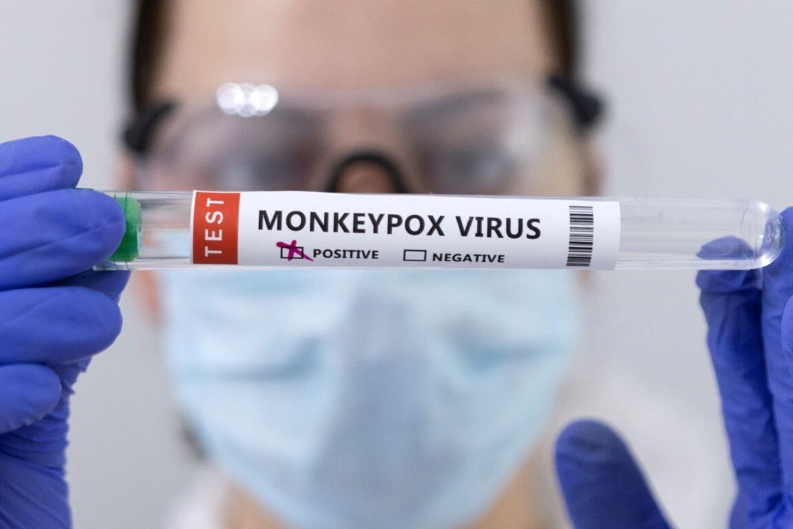 Nouveau cas de Mpox dépisté à Sofia