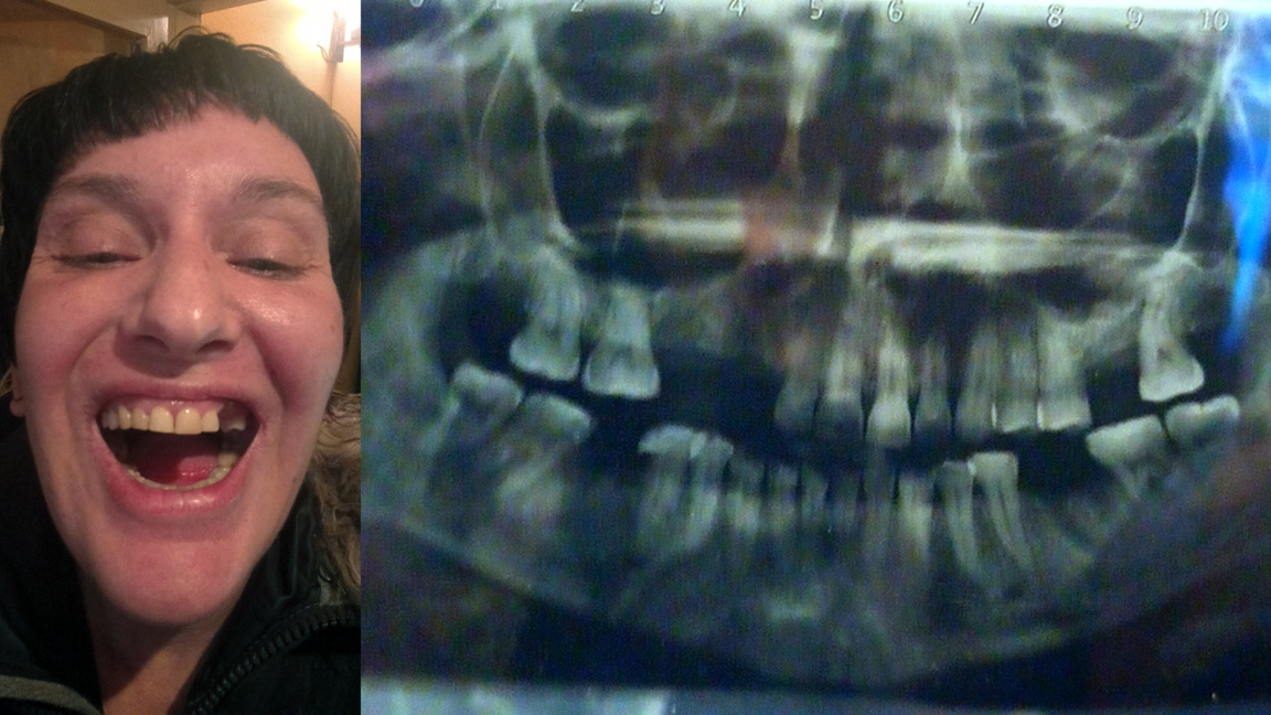 Зов за помощ: 43-годишната Милена се нуждае от спешно лечение на долната челюст