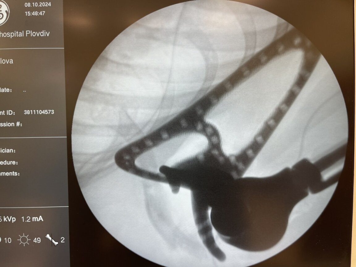 За първи път у нас момиче ще движи ръката си чрез 3D принтирана индивидуална протеза